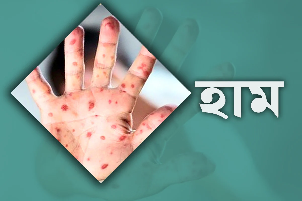 হাম ও উপসর্গে আরও ৫ শিশুর মৃত্যু, শনাক্ত ১২৭