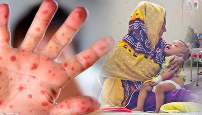 নেত্রকোণায় বাড়ছে হামের সংক্রমণ, মোট আক্রান্ত ১৫১