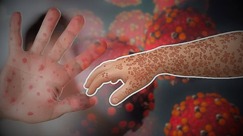 দেশে হাম ও হাম সন্দেহে শিশু মৃত্যু ২৫০ ছাড়াল