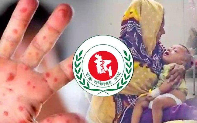 হাম ও উপসর্গ নিয়ে আরও ৩ শিশুর মৃত্যু