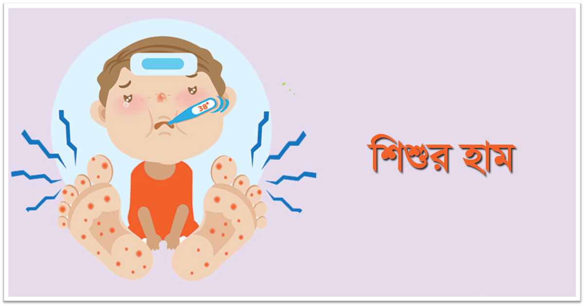 হাম ও হামের উপসর্গ নিয়ে আরও ৯ শিশুর মৃত্যু